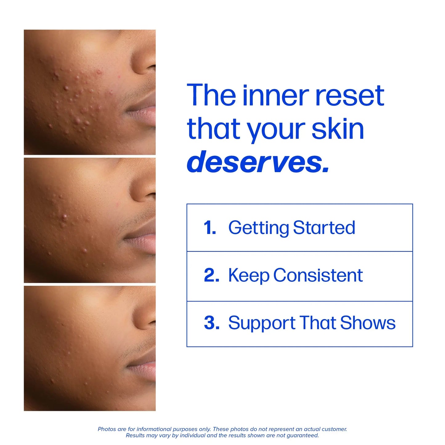 Clear Skin Acne Supplement with Zinc, DIM & Probiotics