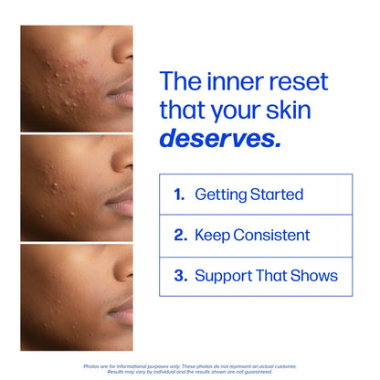 Clear Skin Acne Supplement with Zinc, DIM & Probiotics