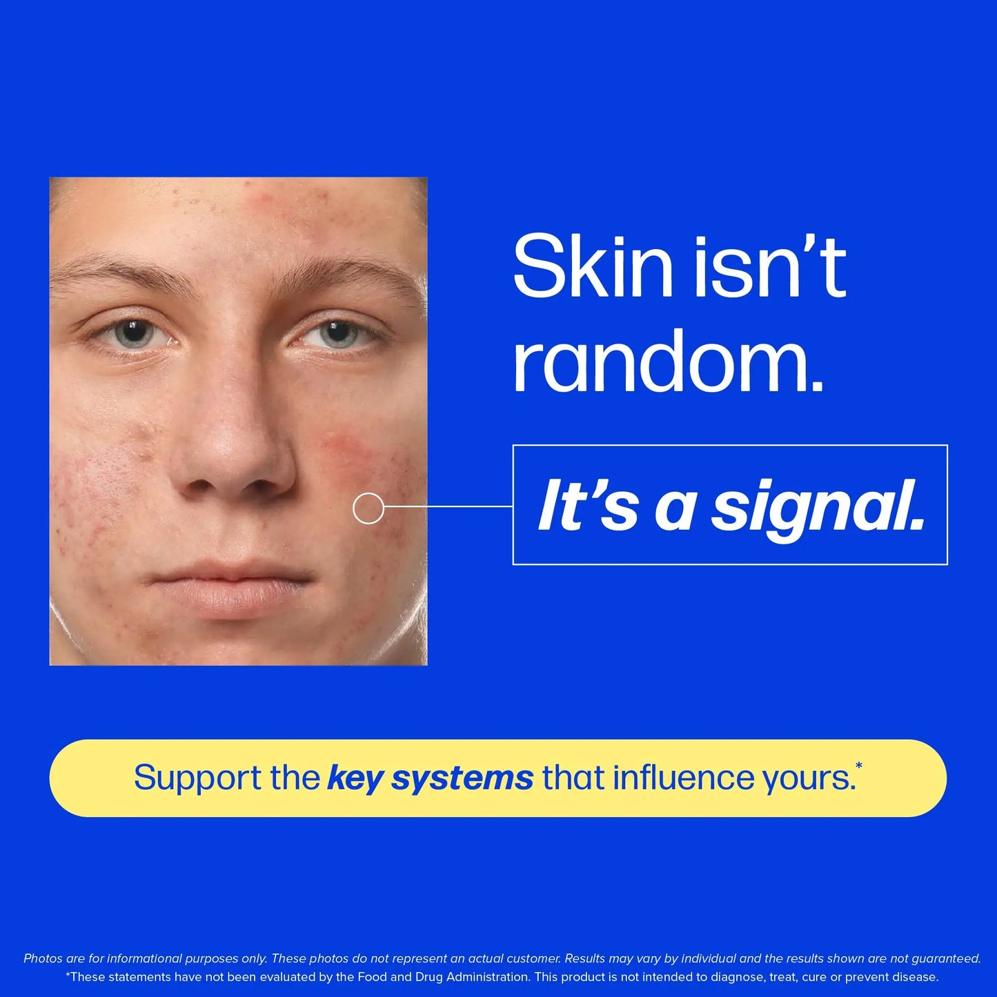 Clear Skin Acne Supplement with Zinc, DIM & Probiotics
